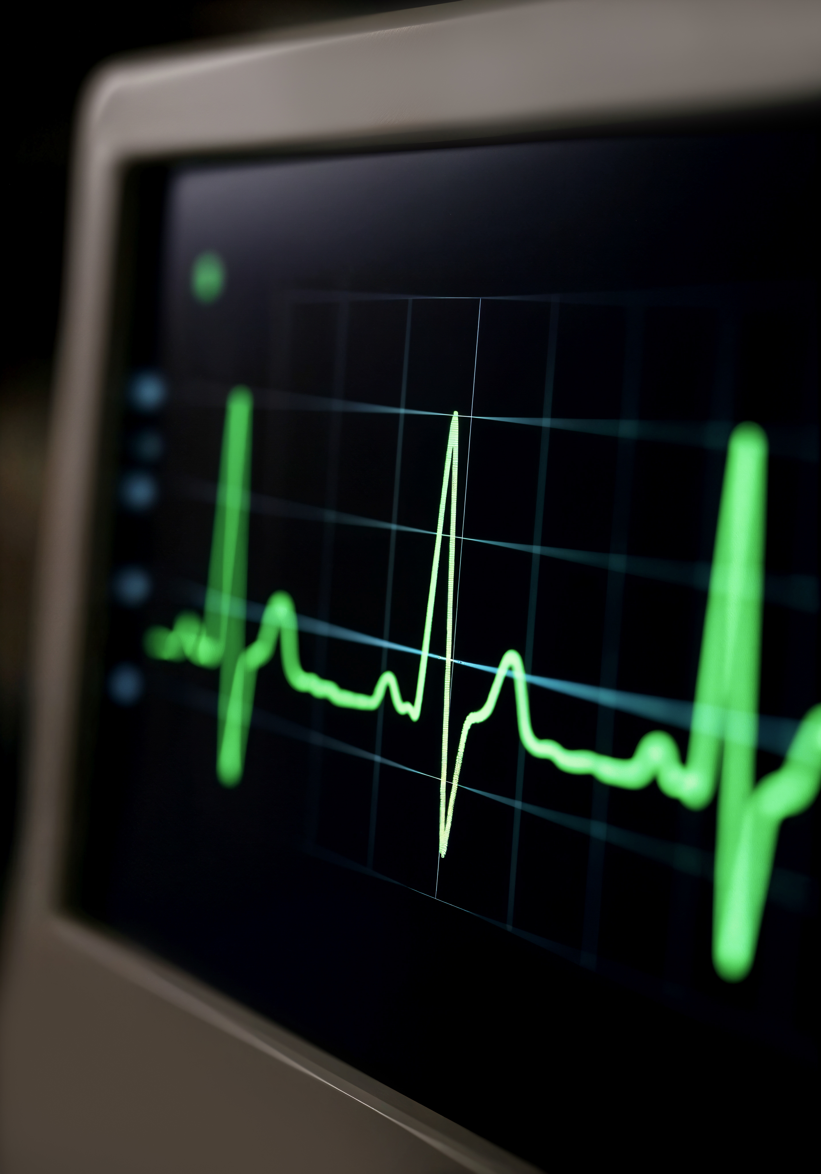 ECG